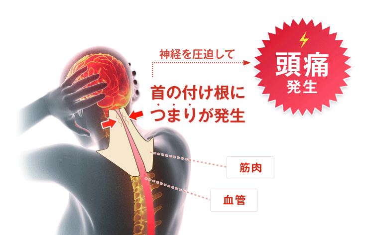 頭痛の原因
